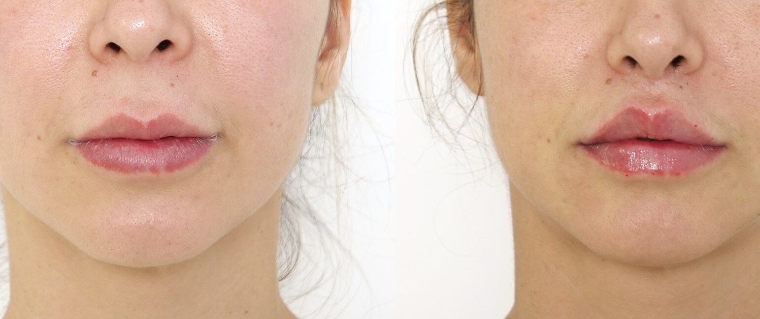 lip+lift